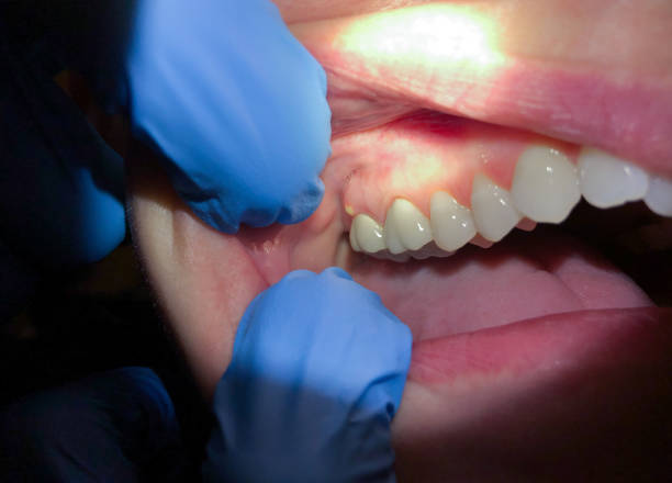 Best Emergency Tooth Extraction in Overton, TX